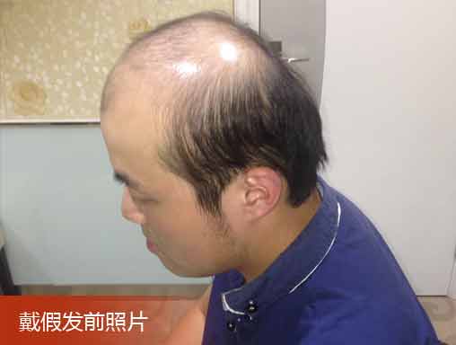 戴假发前照片